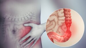 IBS: Food And Beverages That Should Be Avoided