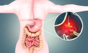 Foods to Eat and Avoid if you’ve Got an Ulcer