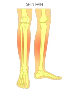 Anterior Compartment Syndrome