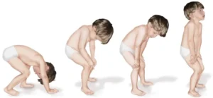 Muscular Dystrophy