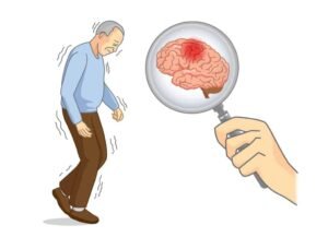Parkinsonism