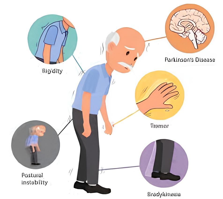 parkinsonism