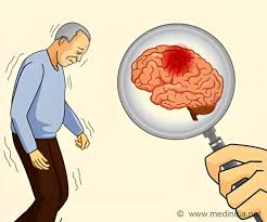parkinsonism