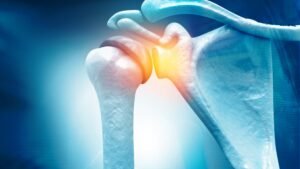 Rotator Cuff Injury