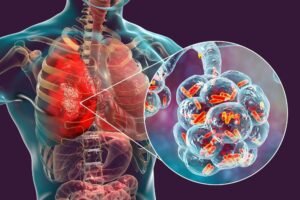 Pneumonia