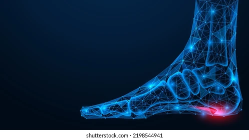 Plantar Fasciitis