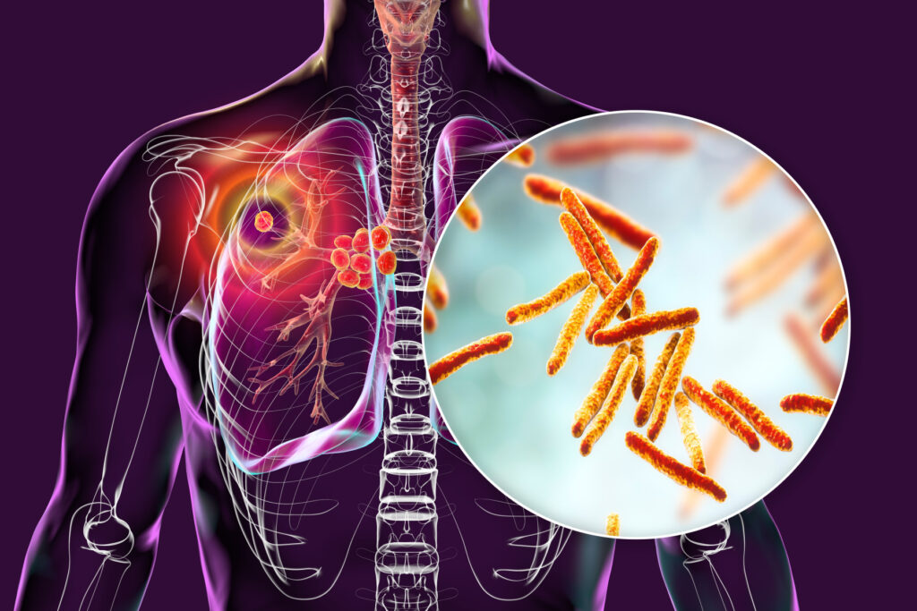 tuberculosis