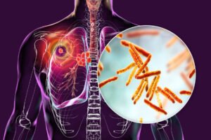 Tuberculosis