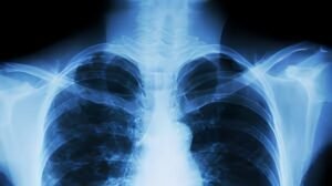 Bronchiectasis 