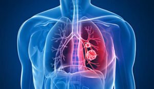 Emphysema