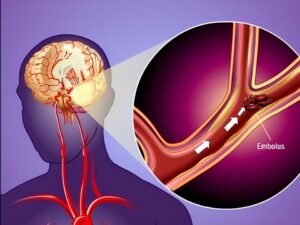Transient Ischemic Attack