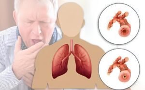 Chronic Obstructive Pulmonary Disease(COPD)