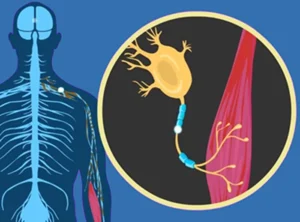 Amyotrophic Lateral Sclerosis( ALS)