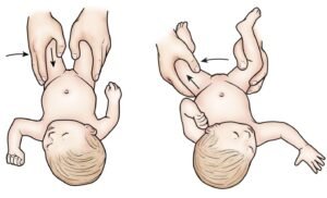 Congenital Hip Dislocation