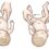 Congenital Hip Dislocation