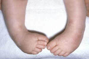 Congenital Talipes Equinovarus(CTEV)