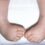 Congenital Talipes Equinovarus(CTEV)
