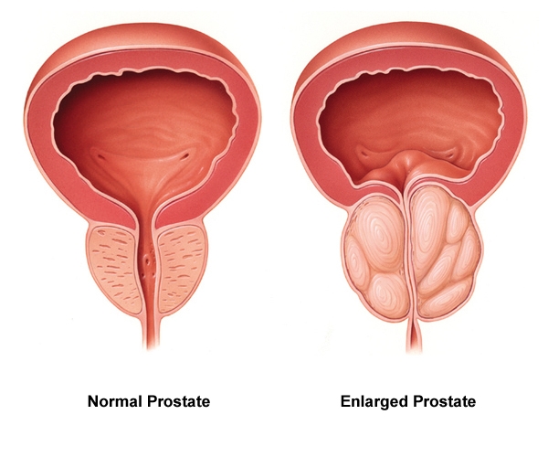 enlarged prostate