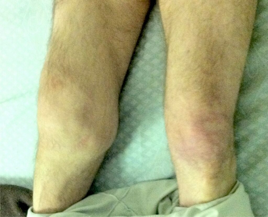 haecot knee joint