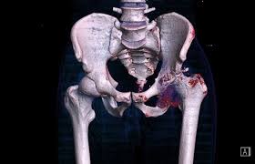 Tuberculosis of hip
