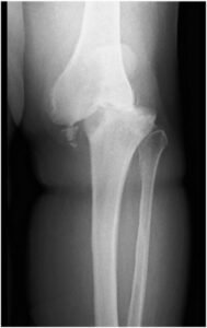 Charcot Knee
