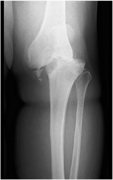 CHARCOT KNEE