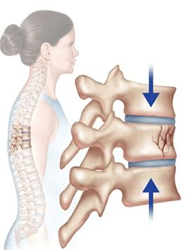 Compression Fracture