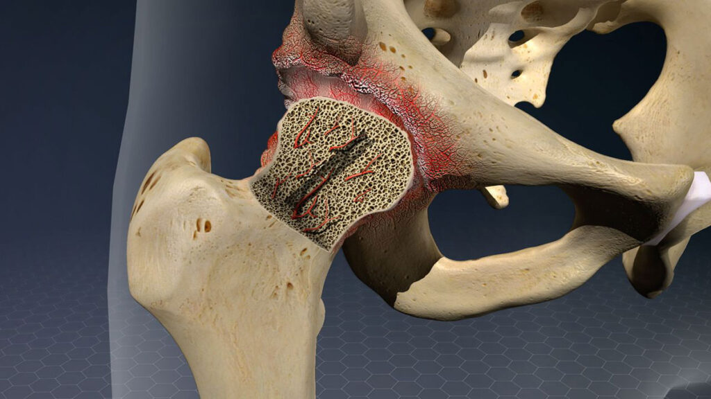 Avascular Necrosis Hip