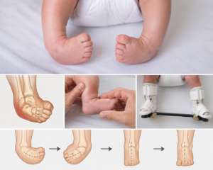 Congenital Talipes Equinovarus (CTEV)