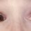 Osteogenesis Imperfecta