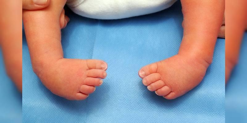 Congenital Talipes Equinovarus (CTEV)