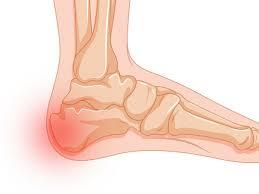Plantar Apophysitis
