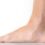 Pes Planus