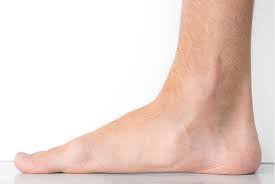 Pes Planus