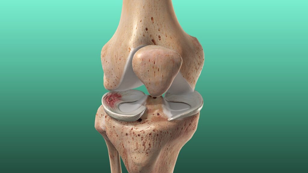 Meniscal Injuries