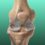 Meniscal Injuries