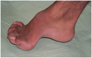 Pes Cavus