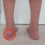 Haglund’s deformity