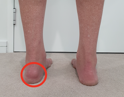 Haglund’s deformity