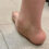 Spring Ligament Injuries