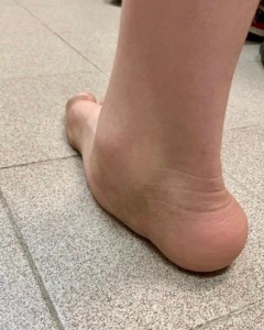 Spring Ligament Injuries