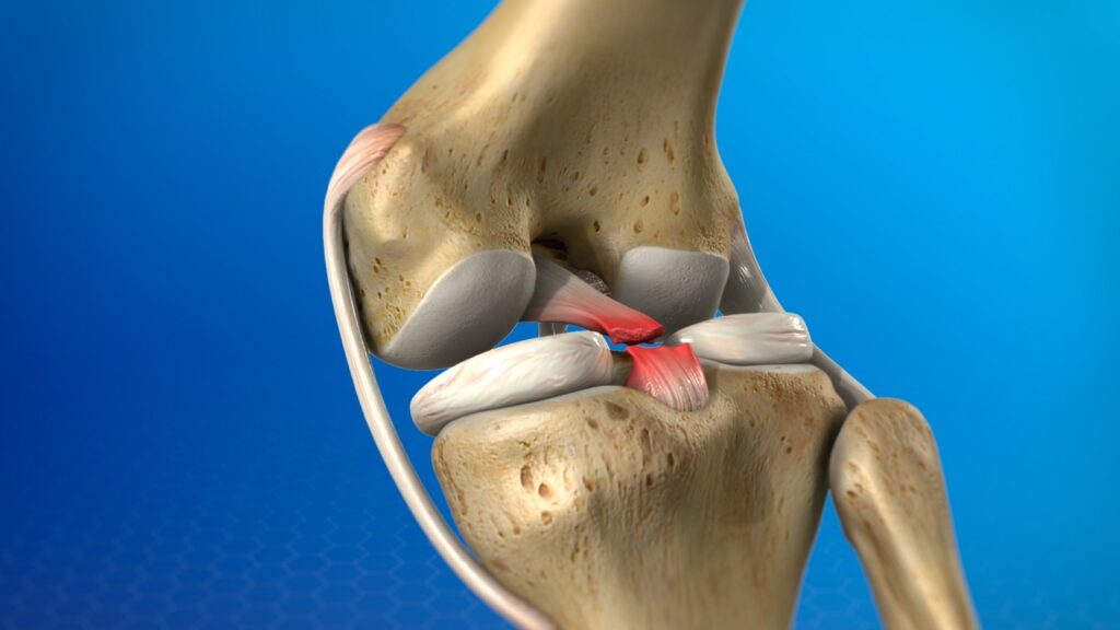 Posterior Cruciate Ligament Injuries