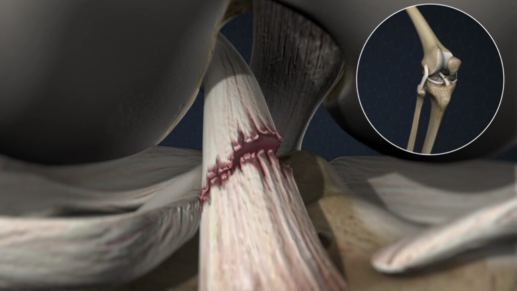 Anterior Cruciate Ligament Injury