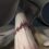 Anterior Cruciate Ligament Injury