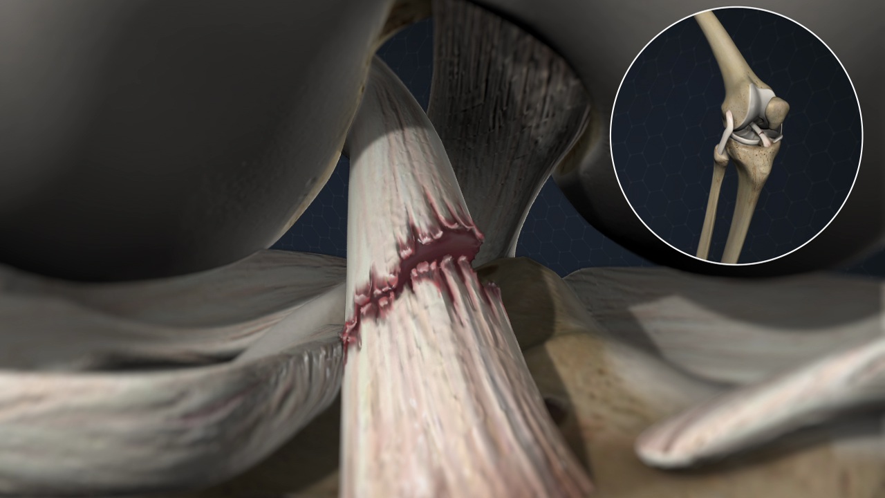 Anterior Cruciate Ligament Injury