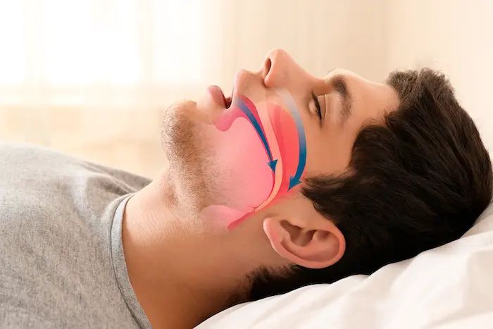 sleep apnea