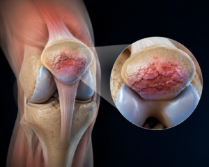 Chondromalacia Patellae