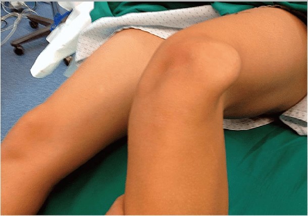 Recurrent Patellar Dislocation