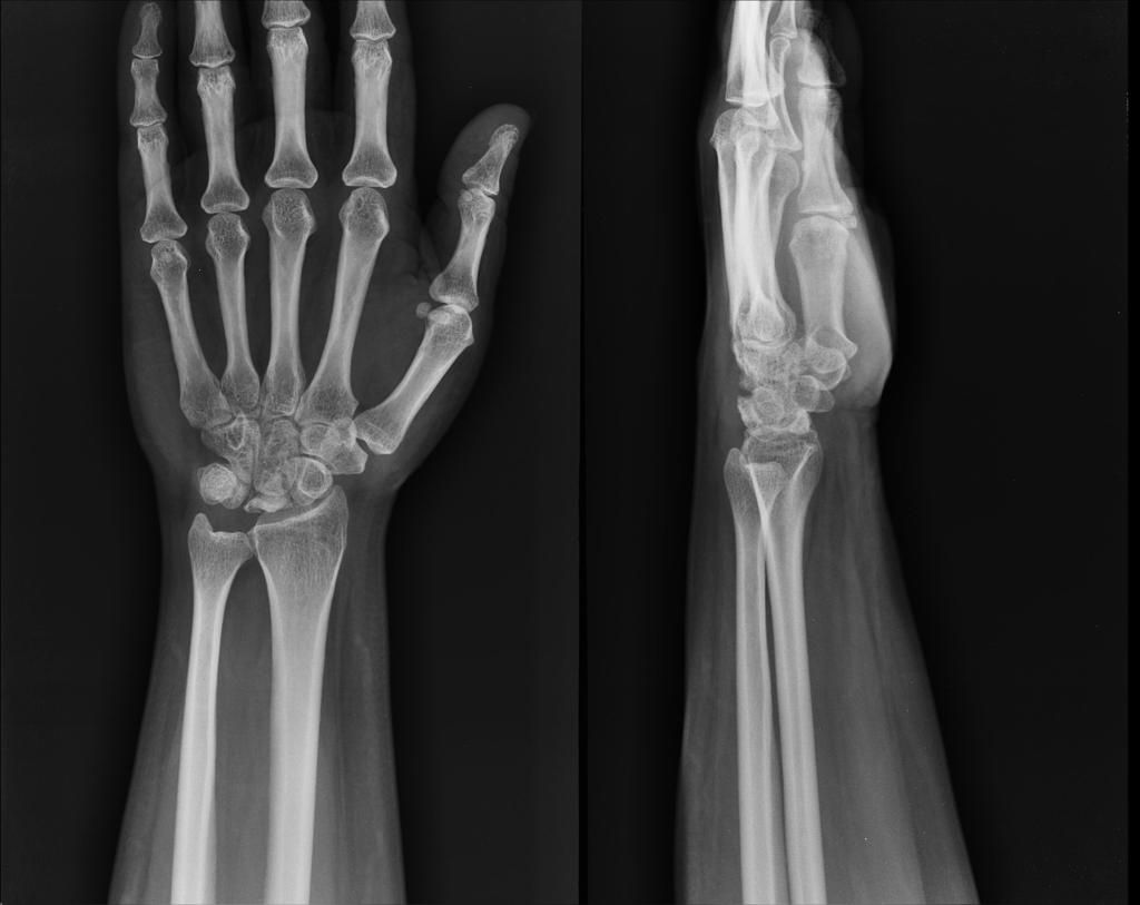 Kienbock’s Disease