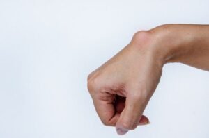 Ganglion Cysts: A Comprehensive Guide for Patients